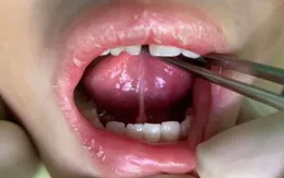 Dính thắng lưỡi - nguyên nhân khiến trẻ chậm nói