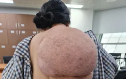 Cứu người phụ nữ gánh trên vai khối u khổng lồ