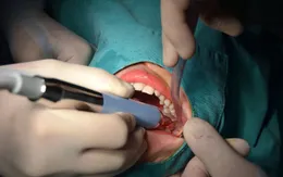 Áp xe vùng mặt - Hậu quả nặng nề khi chủ quan với biến chứng mọc răng khôn