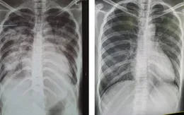 Cứu sống sản phụ bị phù phổi cấp do tiền sản giật nặng
