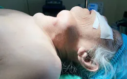 Bướu giáp khổng lồ khiến cụ bà 77 tuổi ăn không ngon, ngủ không yên
