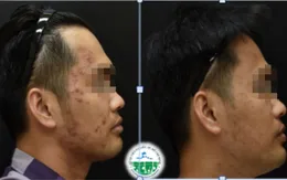 Tăng sắc tố sau viêm: Phòng ngừa và điều trị