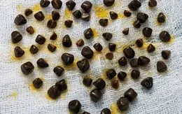 Phẫu thuật nội soi cắt túi mật chứa hơn 80 viên sỏi