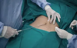 Một phụ nữ 50 tuổi tử vong sau 3 ngày hút mỡ bụng