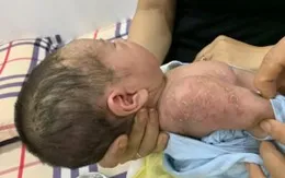 Viêm da mủ ở trẻ sơ sinh - những điều phụ huynh cần lưu ý