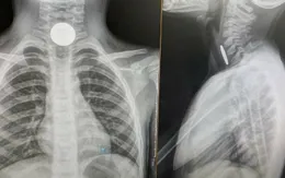 Bé trai 5 tuổi suýt tắc thở vì nuốt phải đồng xu