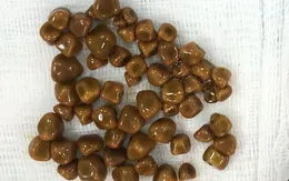 Bác sĩ gắp từ túi mật của bệnh nhân 56 viên sỏi