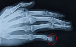 Nam thanh niên bị chó nhà cắn đứt đốt ngón tay, không thể nối lại