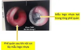Ho kéo dài - Cẩn trọng dị vật đường thở bị bỏ quên ở trẻ