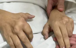 Biến dạng khớp do bệnh gout, bệnh nhân phải phẫu thuật thay khớp gối 2 bên