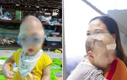 Kéo giãn vòm sọ sau điều trị cho bé gái mắc dị tật sọ mặt hiếm gặp