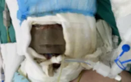 Xông thuốc lá phòng COVID-19, bé gái bị bỏng nước sôi nguy kịch