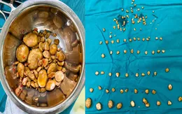 Lấy hàng chục viên sỏi trong bàng quang bệnh nhân