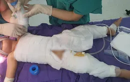 Bé 3 tuổi bỏng nặng do ngã vào nồi nước nóng