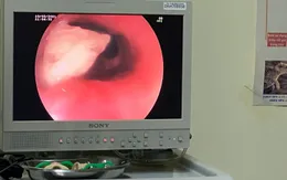 Vào viện cấp cứu ngày cận Tết vì hóc xương gà