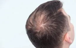 Các nhà khoa học Nhật Bản tìm ra tế bào gốc giúp tái tạo tóc