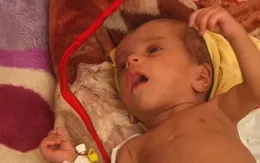 Dịch vụ y tế Yemen “không thể đối phó” với tình trạng trẻ em suy sinh dưỡng