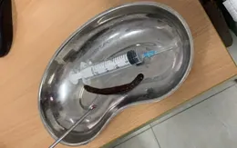 Gắp con vắt dài 20 cm khỏi... mũi người đàn ông