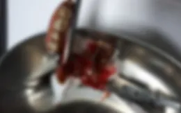 Sau cơn co giật, bị răng giả móc sâu vào hạ họng