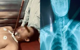 Cứu nam thanh niên bị kẻ trộm chó bắn mũi tên xuyên cổ