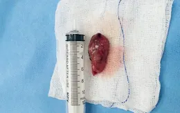 Suýt liệt do u tủy ngực