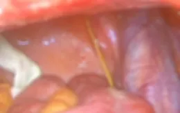 Thủng ruột do thói quen ngậm tăm khi ngủ