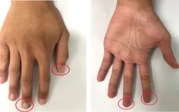 Nam thanh niên 20 tuổi bị hoại tử ruột non do hội chứng Peutz Jeghers