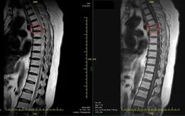 Bơm xi măng điều trị cho bệnh nhân xẹp đốt sống do ngã đập lưng trên sàn cứng
