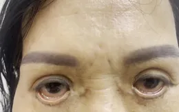 Mắt bị trợn ngược vì cắt mí tại spa