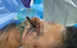 Gặp tai nạn xe máy, nam thanh niên bị thanh sắt bên đường cắm xuyên mặt