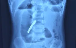 Bé gái 2 tuổi bị thủng ruột do nuốt 7 viên bi nam châm