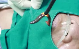 Thường xuyên uống nước suối khi làm rẫy, người đàn ông bị vắt ký sinh trong khí quản