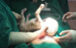 Bé sơ sinh chào đời với làn da bao phủ vảy trắng, bong từng mảng lớn