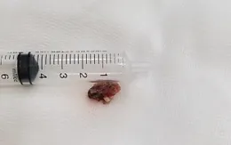Đau đầu lâu ngày, đi khám phát hiện có khối u trong não