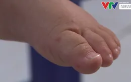 Nhiều trẻ mắc tay chân miệng nhập viện muộn