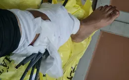 Va chạm với xe ba gác chở sắt, nam thanh niên bị 11 thanh sắt đâm xuyên chân