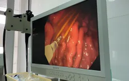 Lấy cùng lúc 3 cây tăm tre trong dạ dày bệnh nhân