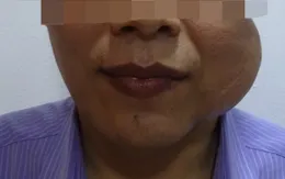 Giải thoát cho nam bệnh nhân khỏi khối u khổng lồ trên má từng 3 lần bị từ chối điều trị
