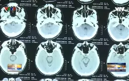 Tác hại nghiêm trọng của ngộ độc rượu