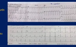 Cứu sống bệnh nhi 9 tuổi nhịp tim nhanh kịch phát 229 lần/phút