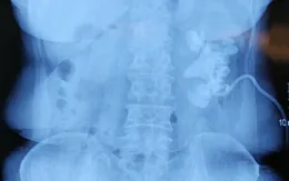 Người phụ nữ có sỏi san hô rải rác khắp thận, nhiều bệnh viện "từ chối" phẫu thuật