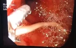 Bé 5 tuổi viêm tụy cấp do giun dài 15cm chui vào ống tụy