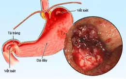 Phụ thuộc corticoid - bài học đắt giá