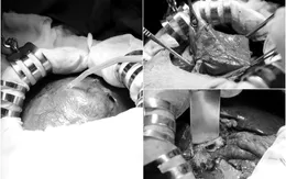 Phẫu thuật nang đường mật "khổng lồ" cho bệnh nhân người dân tộc thiểu số