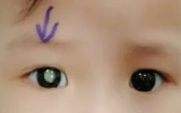 Cảnh báo ung thư nguyên bào võng mạc ở trẻ