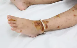 Bé 3 tuổi nhập viện do biến chứng bệnh thủy đậu