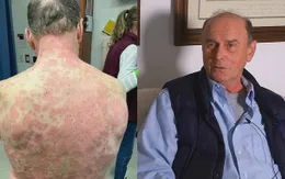 Bị bong tróc da sau tiêm vaccine của Johnson & Johnson