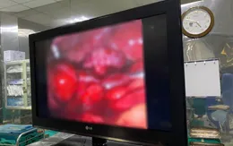 Sốt, đau bụng, vào viện phát hiện áp xe buồng trứng