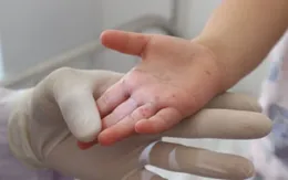 TP. Hồ Chí Minh ghi nhận hơn 7.600 ca mắc tay chân miệng