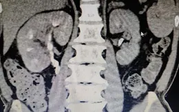 Phẫu thuật điều trị cho bệnh nhân ung thư tế bào thận dạng Sarcoma